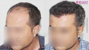 Factors To Be Considered Before Undergoing Hair Transplantation