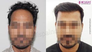 What is The Most Appropriate Hair Transplant Method For High Grade Baldness?