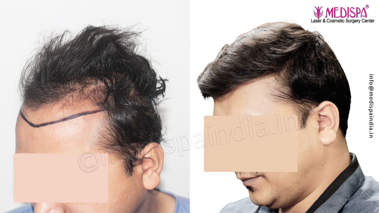best hair transplant in delhi