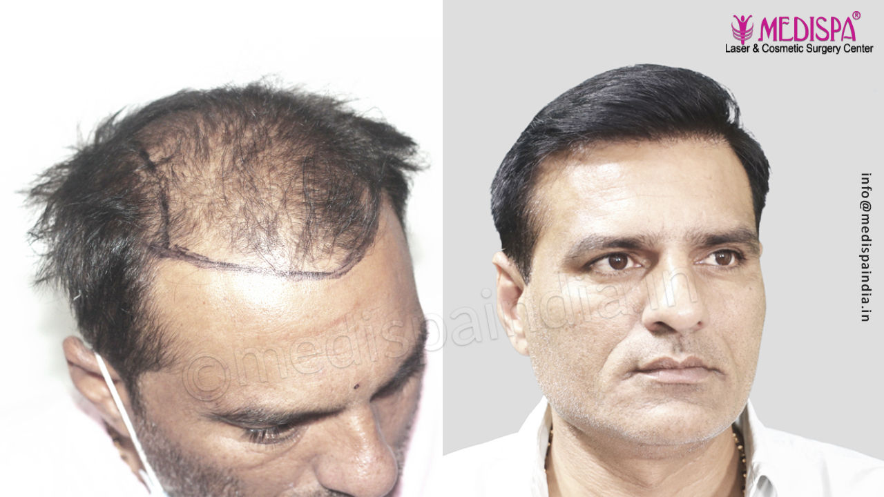 Best hair transplant results in Rajasthan