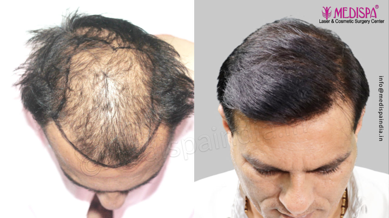 best results for hair transplant