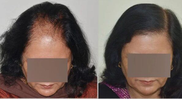 Explain The Important Facts Related With Female Hair Transplant