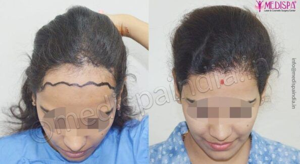 Is Hair Transplant For Women Effective
