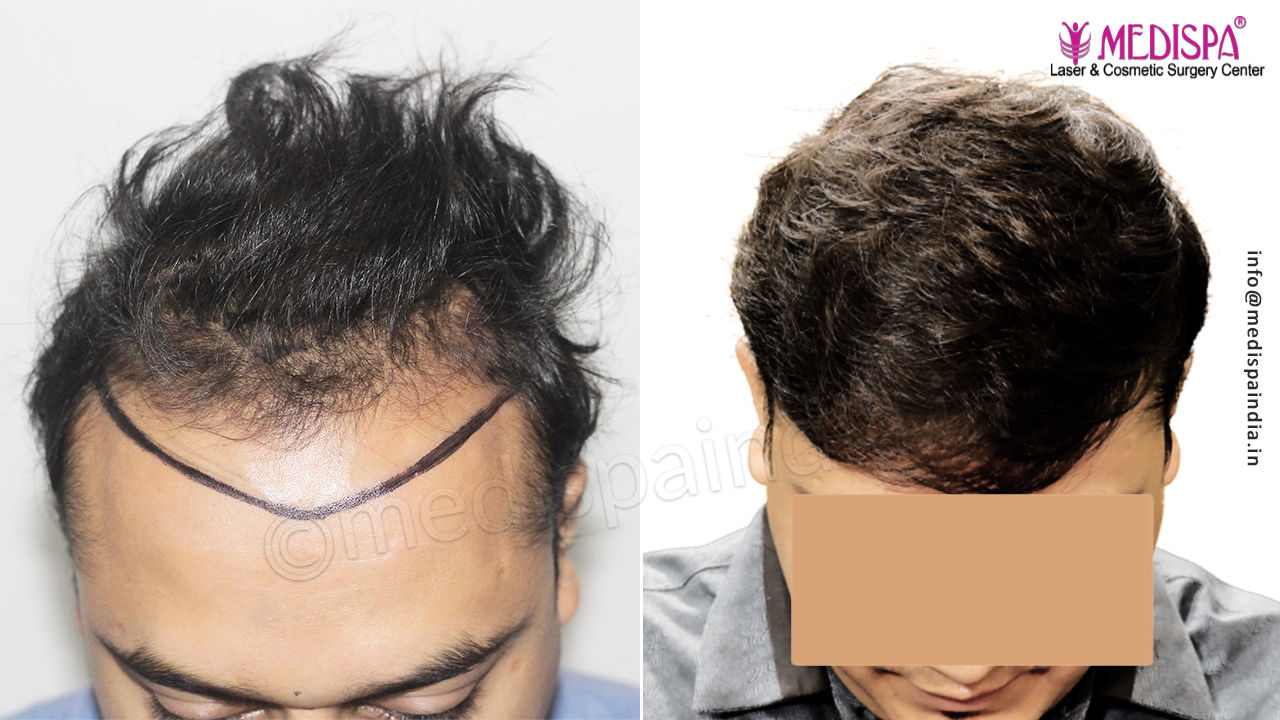 hair restoration in delhi