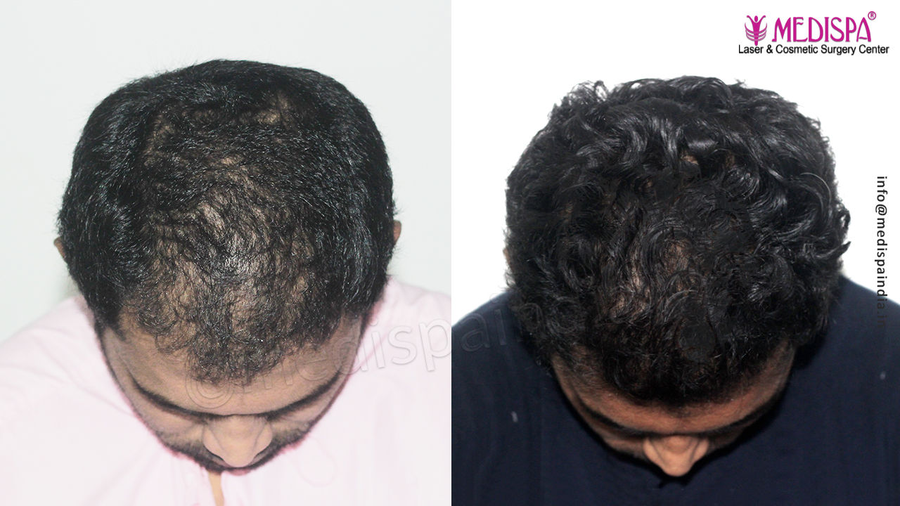 hair transplant before after in chennai