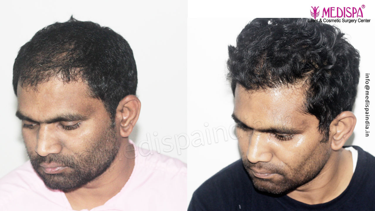 hair transplant before after in delhi