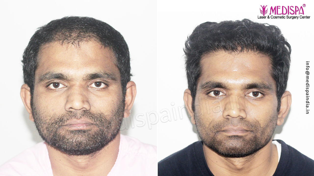 hair transplant before after in india