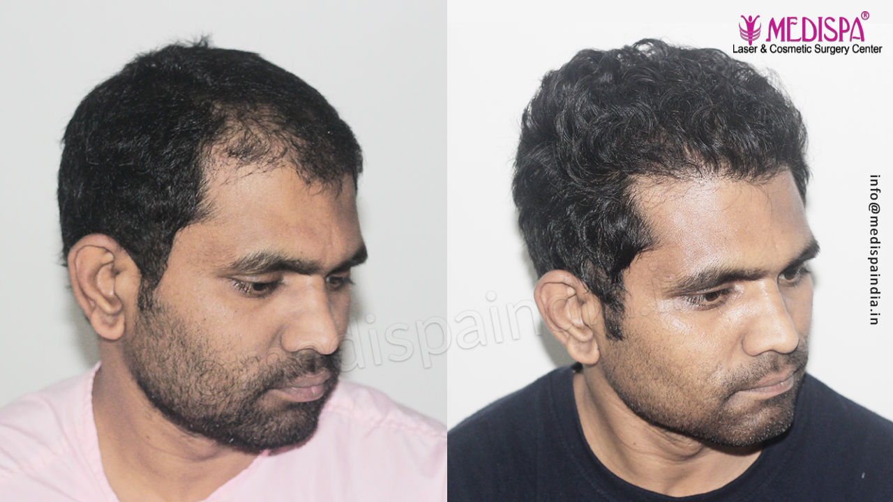 hair transplant before after in mumbai