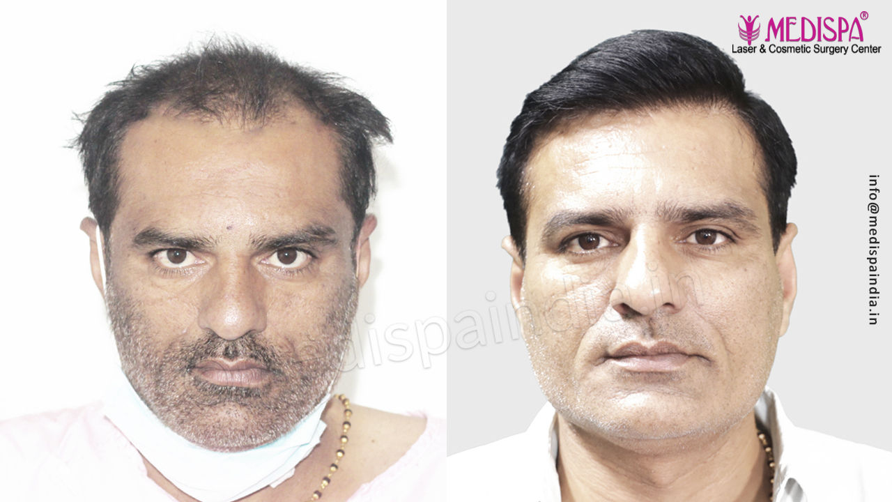 hair transplant rajasthan cost