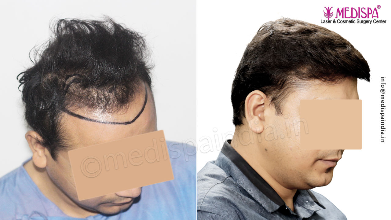 hair transplant results in delhi