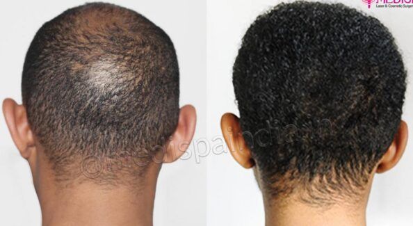 Does The Transplanted Hair Last Forever