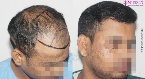 How Can Hair Transplant Help in Getting Rid of Pattern Baldness?