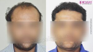 When Should You Decide To Undergo Hair Transplant Treatment?