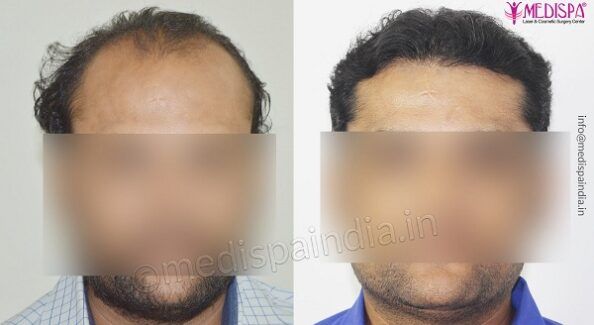 When Should You Decide To Undergo Hair Transplant Treatment