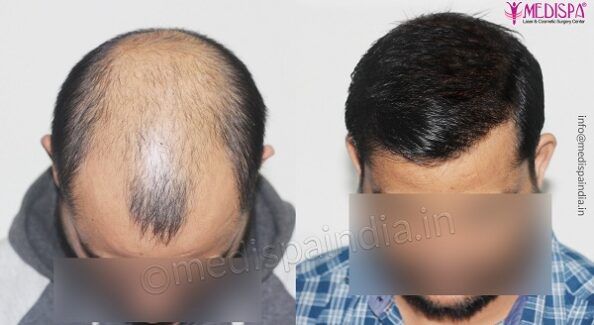How Much Does It Cost To Transplant A Full Head of Hair?