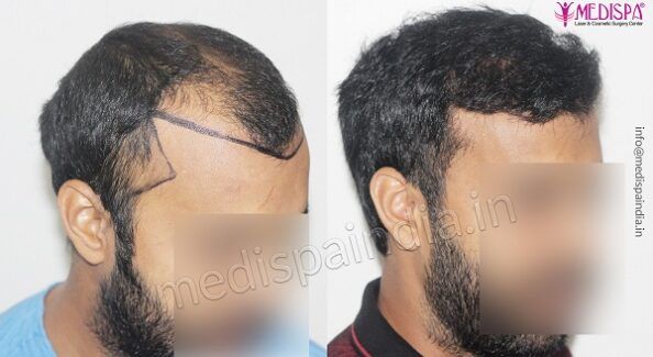 What Are The Parameters To Choose The Best Hair Transplant Clinic?