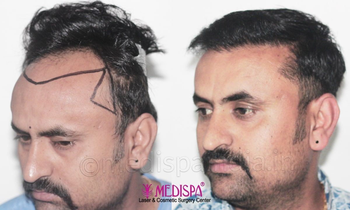 best hair transplant cost in delhi