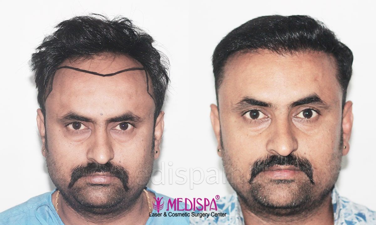 best hair transplant results in India