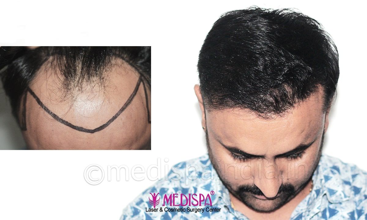 best hair transplant result in delhi