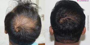 Explain The Stages of Baldness And How Hair Transplant Can Help?