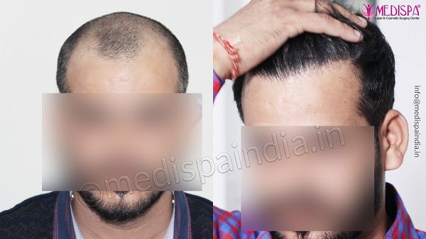 Hair Transplant in Hyderabad