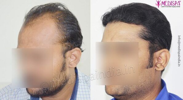 Who is The Suitable Candidate for Hair Transplantation?