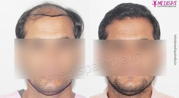 Hair Transplant in Delhi