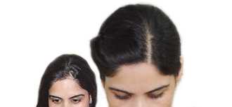 hair transplant before after results