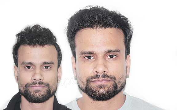 affordable hair transplant cost in india