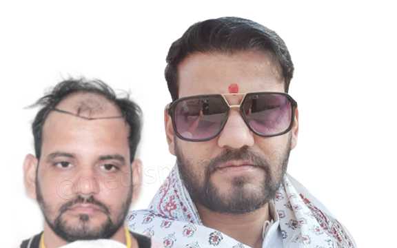 hair transplant results in india