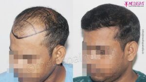 How To Get Natural Hairline With Hair Transplantation?