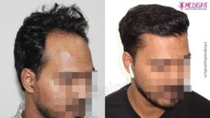 Why Does A Qualified And Experienced Surgeon is Preferred For Hair Restoration?