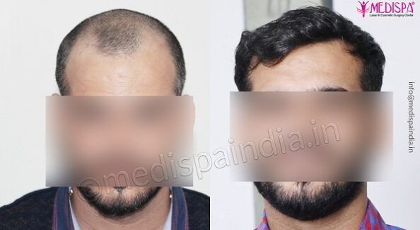 Hair Transplant: A Life-Changing Decision