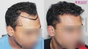 Restore Your Hairline With Hair Transplant Surgery