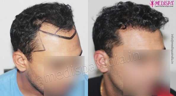 Restore Your Hairline With Hair Transplant Surgery