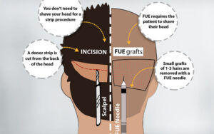 Hair Transplantation Techniques: FUE VS FUT