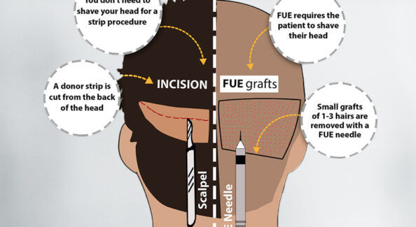 Hair Transplantation Techniques: FUE VS FUT
