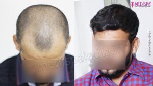 How To Evaluate The Results of Hair Transplant Surgery?
