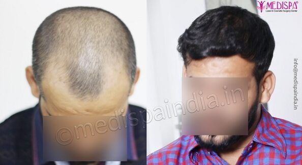 How To Evaluate The Results of Hair Transplant Surgery?