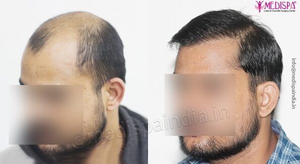 Overcoming High Baldness: The Benefits of Hair Transplant