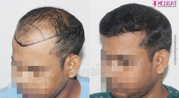 How To Maximize Hair Growth Rate After Hair Transplant?