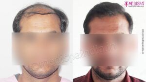 How To Ensure Your Hair Transplant Surgery is A Success?