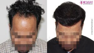 What Should Be Considered Whiling Choosing The Clinic For Hair Transplantation?