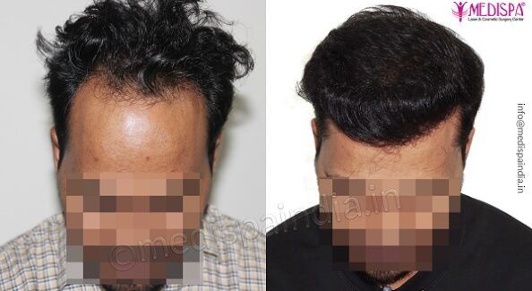 What Should Be Considered Whiling Choosing The Clinic For Hair Transplantation?