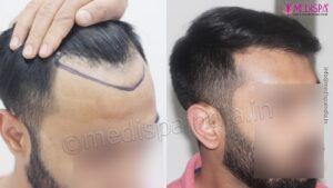 Why Planning Your Hairline is An Integral Part of Hair Transplant?