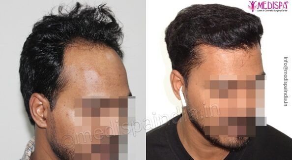 Why Scalp Assessment is Mandatory Before Hair Transplant?