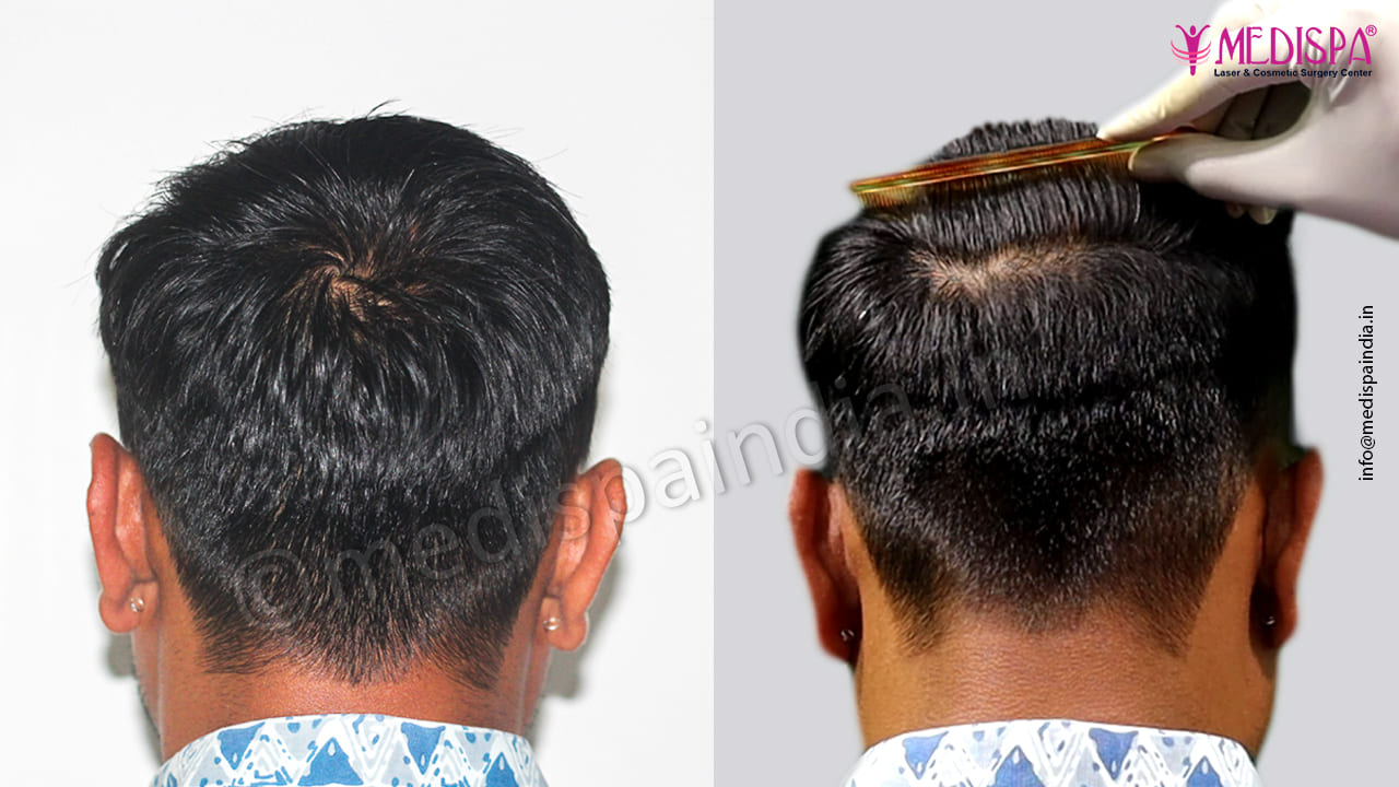 Back Head - After & Before