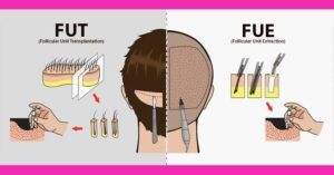 What Are The Dissimilarities Between FUT And FUE Hair Transplant?