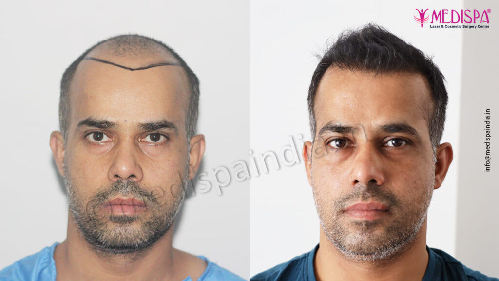 hair restoration results india