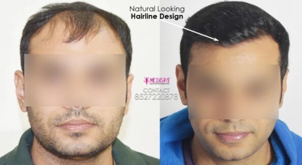 How Long Does A Hair Transplant Procedure Take?
